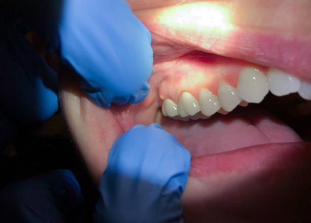 Best Tooth Infection Emergency Dentist  in Commerce, GA